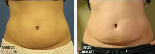 Coolsculpting sales post pregnancy