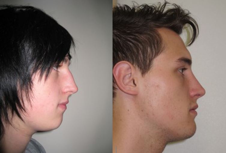 pre rhinoplasty