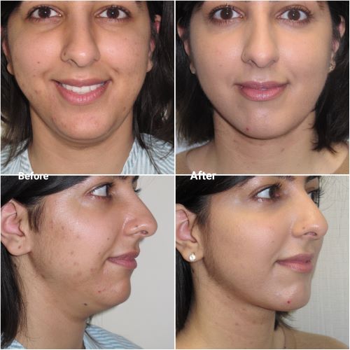 VASER lipo to chin and neck