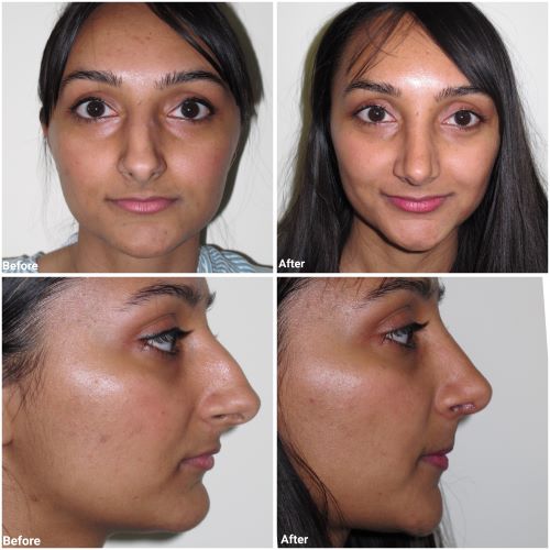 ultrasonic rhinoplasty before and after by Jag Chana
