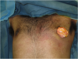 gynaecomastia correction surgery