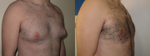 gynaecomastia before and after