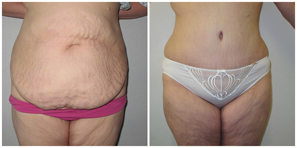 Brazilian Abdominoplasty with Mr Jag Chana