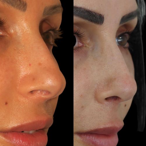 what is a bifid nasal tip