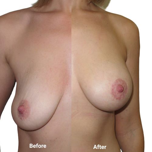 Breast uplift with implants | circumareolar lift | 315cc anatomical teardrop implants