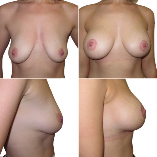 Breast uplift with implants | circumareolar lift | 315cc anatomical teardrop implants