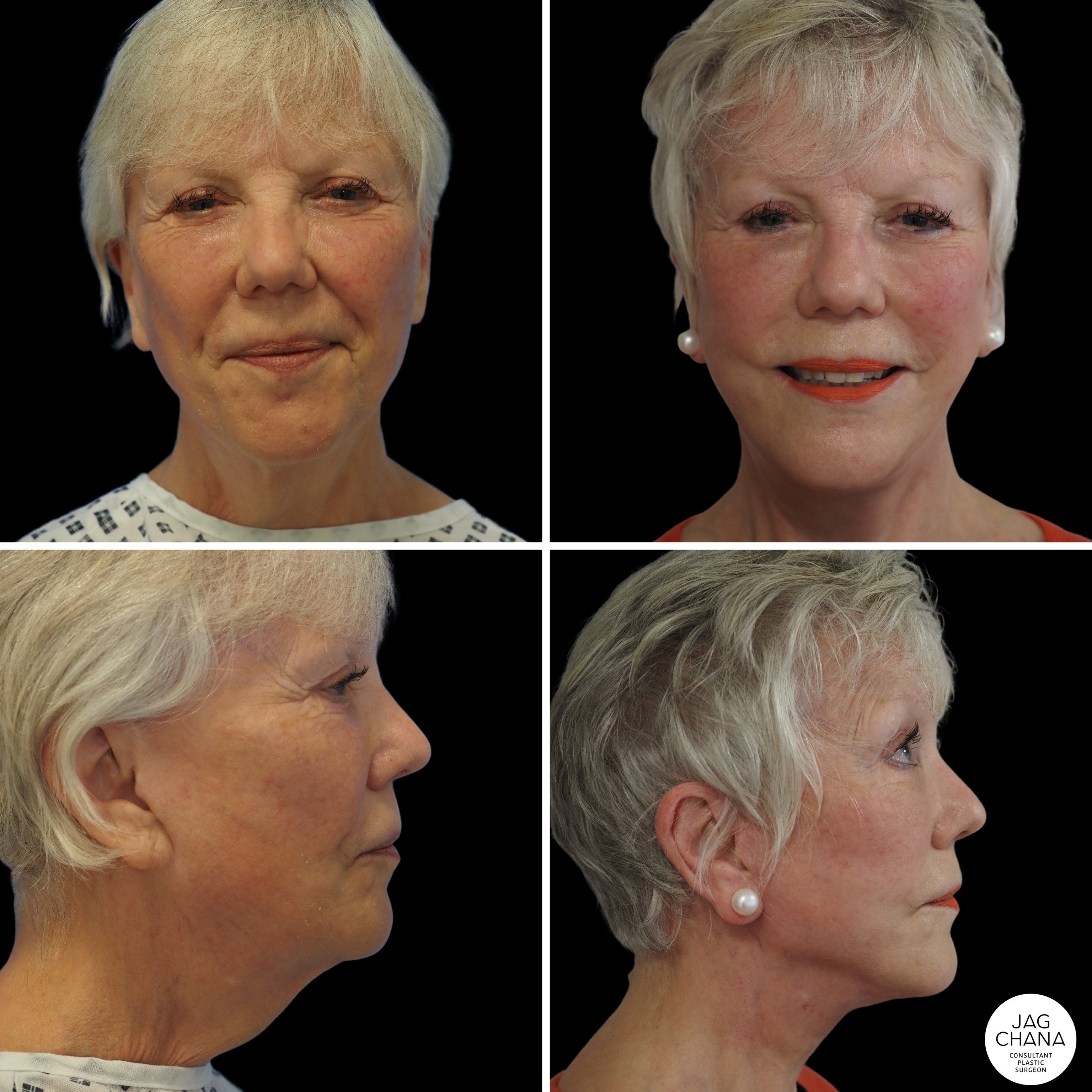 best procedure for sagging jowls 2020 uk Raleigh Hickman