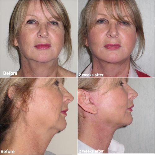 facelift with submental liposuction 2 week receovery jag chana