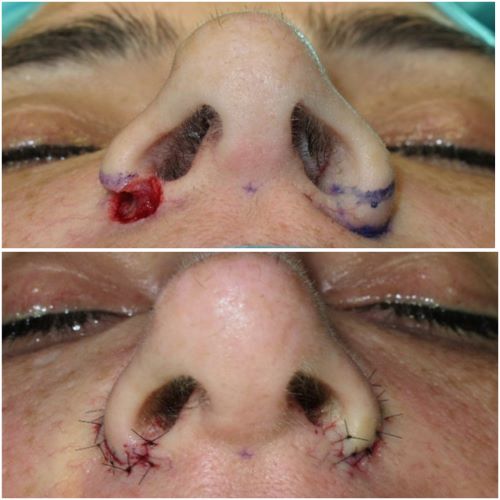 nostril reduction