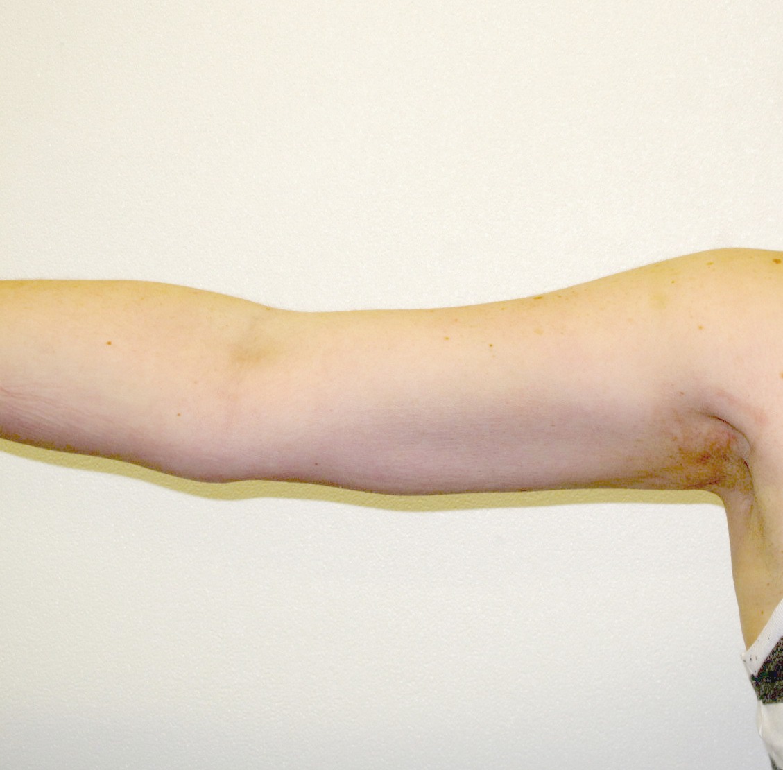 upper arm after